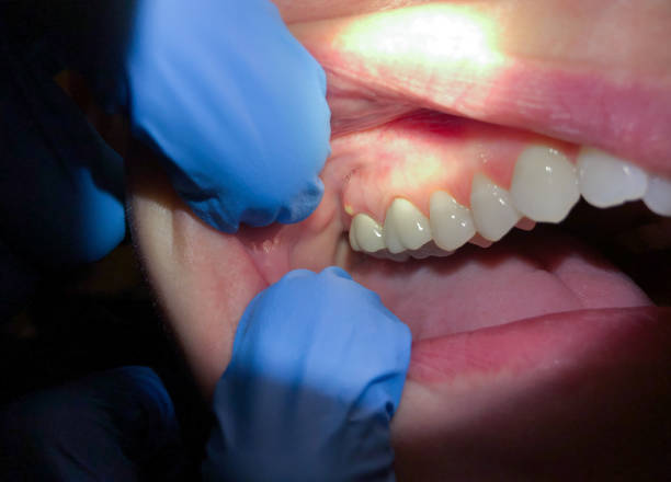 Best Knocked-Out Tooth Emergency  in Cudahy, CA